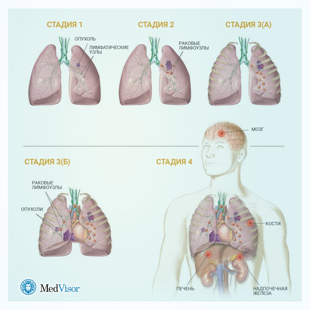 Онкология лёгкого симптомы