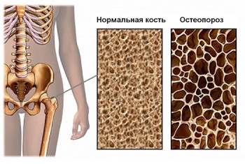 osteoporoz-2