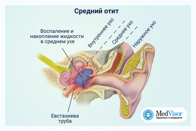 Что делать если продуло ухо и болит. Воспаление слуховой евстахиевой трубы.