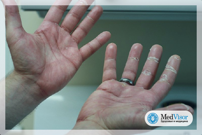 Аллергия на антисептики для рук: признаки, лечение