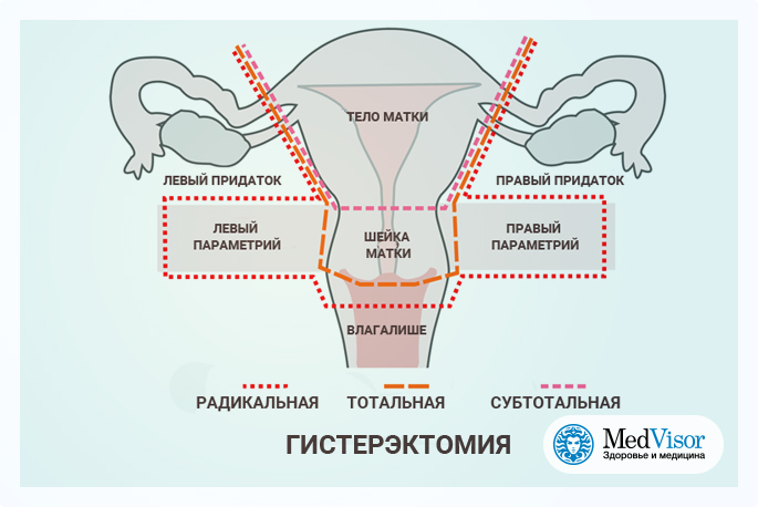 Сколько больничный после удаления матки полостная операция. Радикальная гистерэктомия. Гистерэктомия и экстирпация матки.