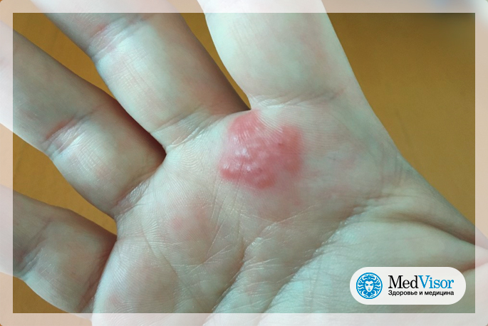 Аллергический контактный дерматит на руках 